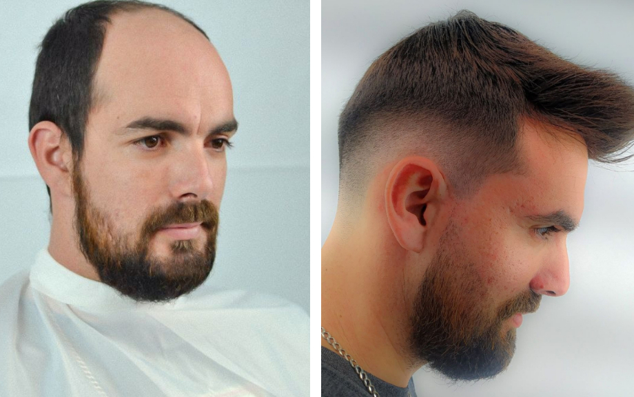 Nuevo servicio de prótesis capilares en San Lorenzo